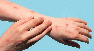 Maymun çiçeği salgını, pandemiye dönüşür mü?