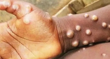 Sağlık Bakanlığı'ndan Maymun Çiçeği uyarısı !..