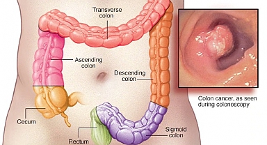 Kolorektal kanserlerin görülme yaşı düşüyor